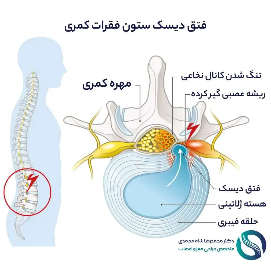 فتق دیسک کمر چیست؟ دکتر شاه محمدی متخصص جراح دیسک کمر