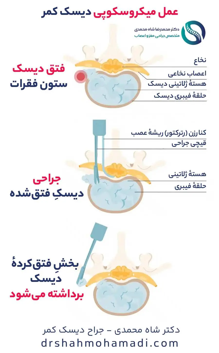 عمل میکروسکوپی دیسک کمر - دکتر محمدرضا شاه محمدی جراح دیسک کمر در تهران