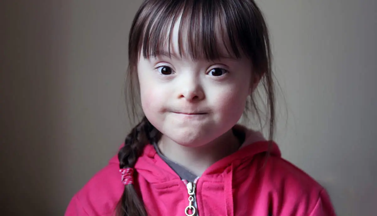 بیماران سندرم داون با این روش درمان میشوند