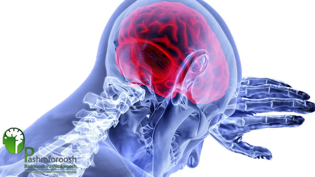 فوق تخصص سکته مغزی چه بیماری هایی را درمان میکند؟