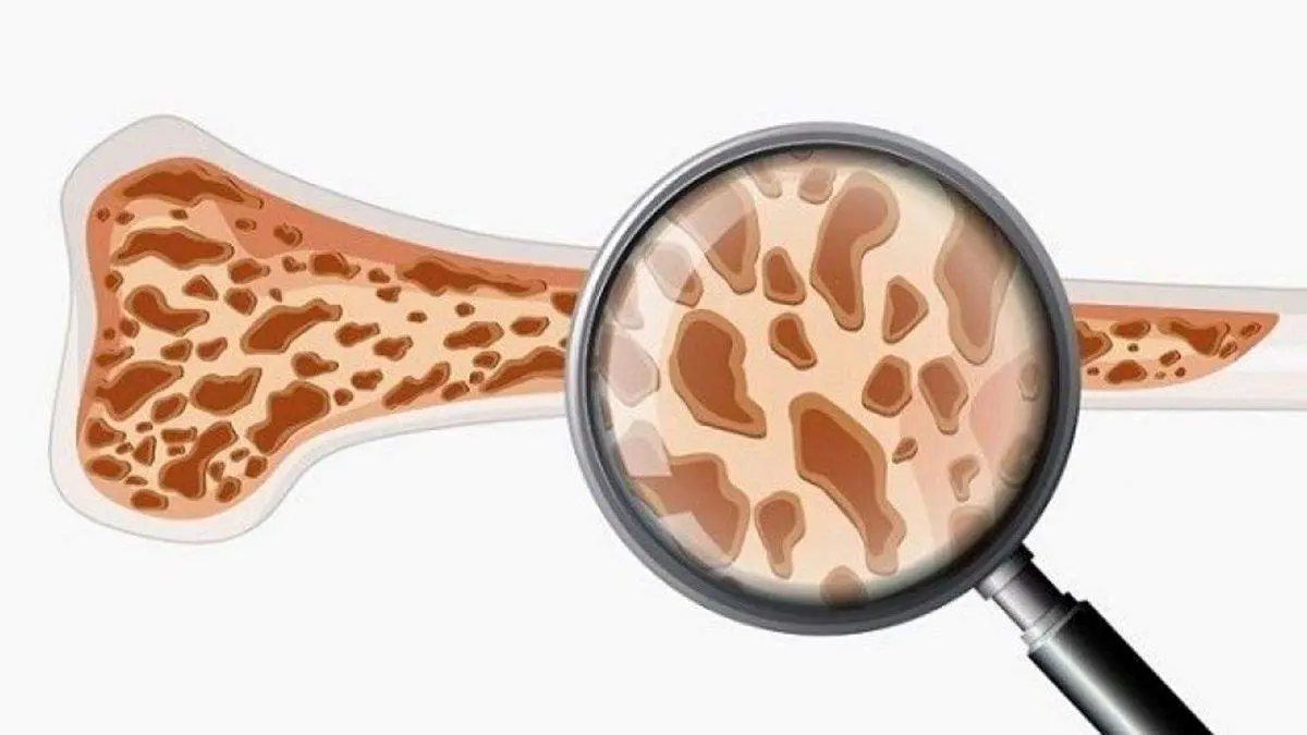 هشدار درباره یک نوع اختلال اسکلتی که جانتان را به خطر میاندازد