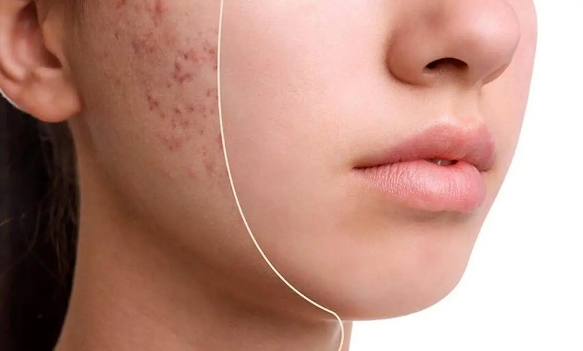 این علائم پوستی نشانه تغذیه ناسالم است