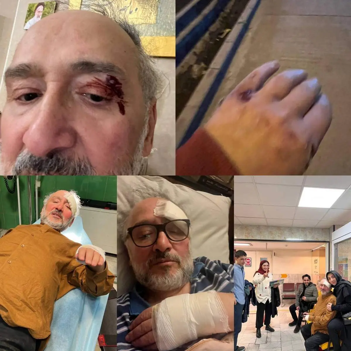 حمله به ابطحی برای دزدیدن موبایلش؛ قفسه سینه ترک خورد و 10 بخیه روی ابرو/ عکس