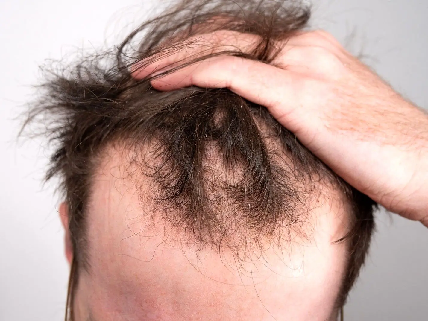 شایع ترین علل ریزش مو چیست؟