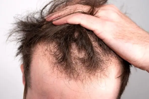 شایع ترین علل ریزش مو چیست؟