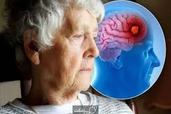 این نشانه ها هنگام خواب علامتهای اولیه ابتلا به آلزایمر است!