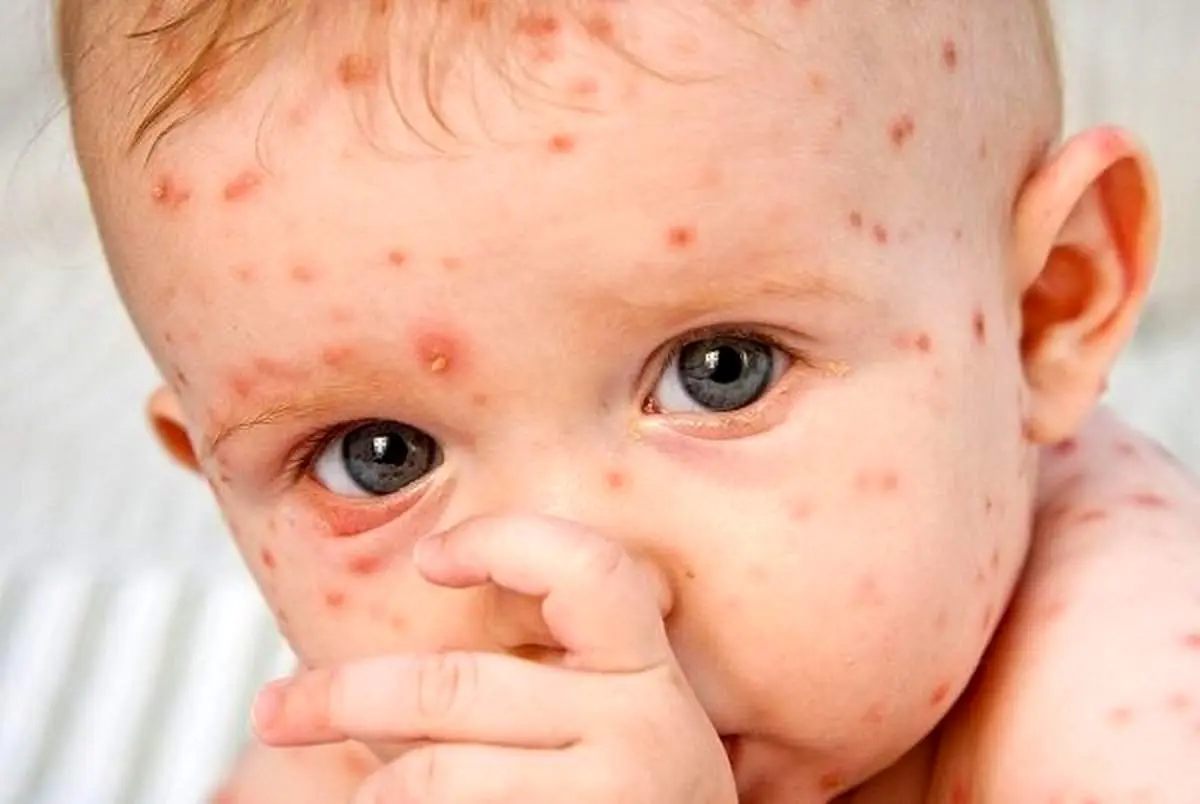 ابتلای کودکان به آبله مرغان خطرناک است؟