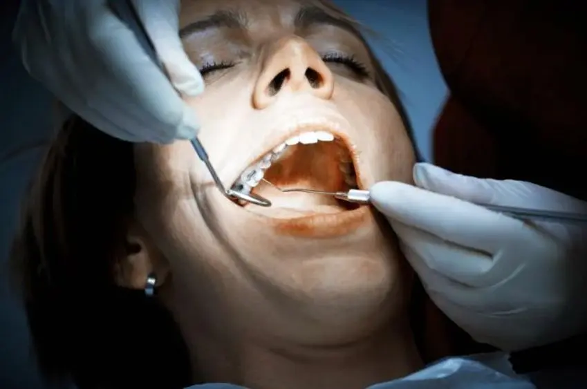 ارتباط بین عصب‌کشی و پر کردن دندان