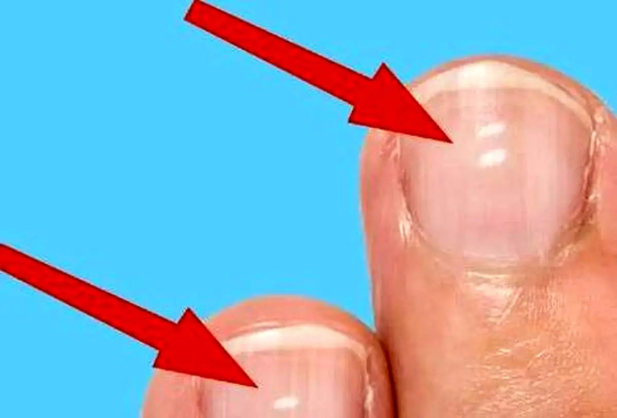 علت لکه های سفید روی ناخن ها چیست؟