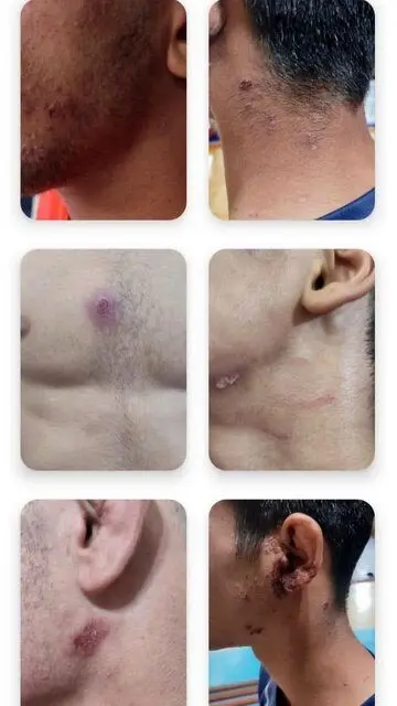  ابتلای کشتی‌گیران اندیمشکی به بیماری پوستی/ تصاویر