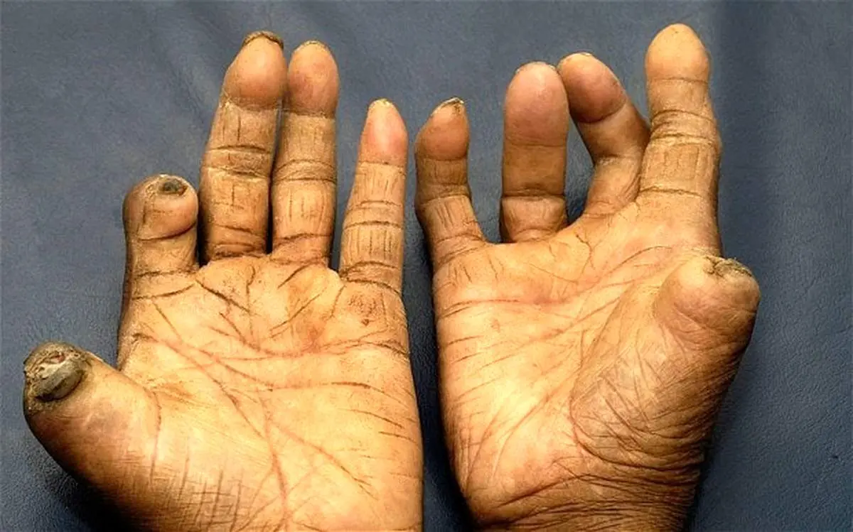 شیوع بیماری جذام در کشور صحت دارد؟