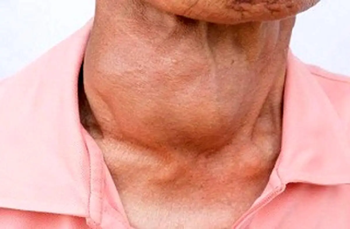 چطور تیروئید کم کار را کنترل کنیم؟