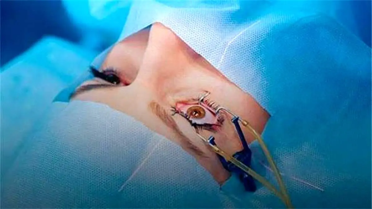 آیا جراحی چشم شامل بیمه تکمیلی می‌شود؟