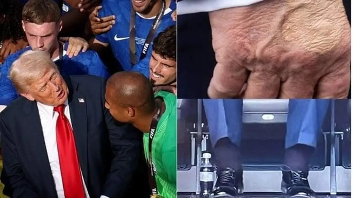 کبودی روی دست‌های ترامپ نشانه چیست؟