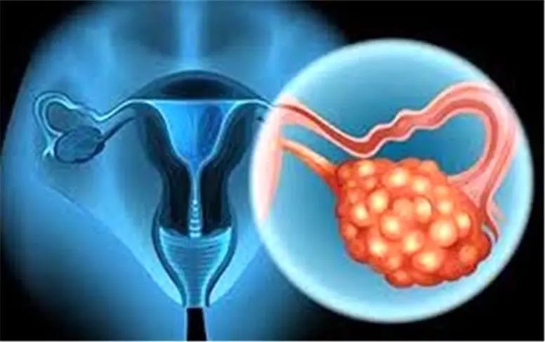 هشدار به زنان ؛ این بیماری ساده ممکن است نشانه‌ای از  سرطان تخمدان باشد