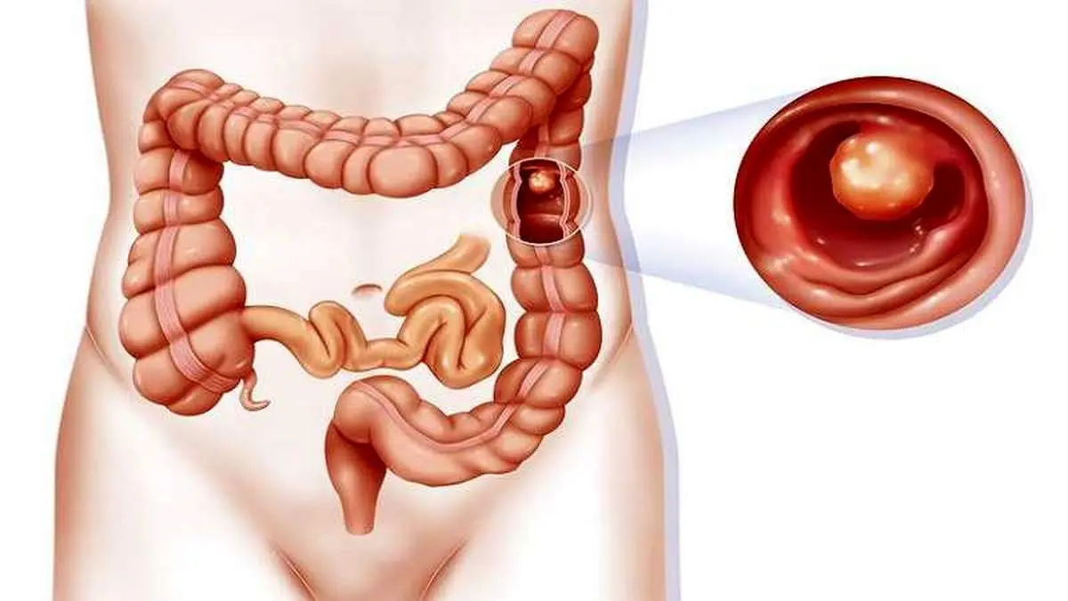مقابله آسپرین با سومین سرطان شایع جهان؟