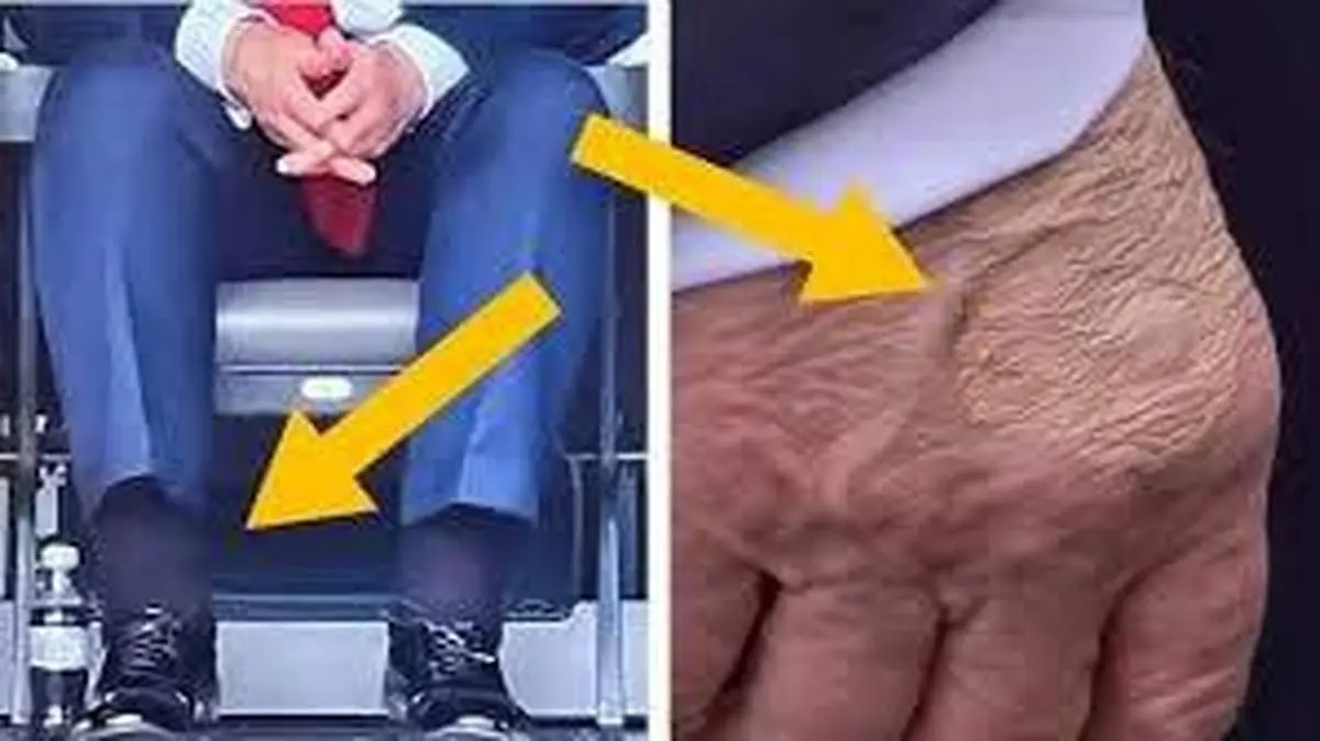 بیماری مزمن  ترامپ خبرساز شد