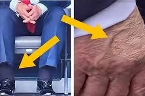 بیماری مزمن  ترامپ خبرساز شد
