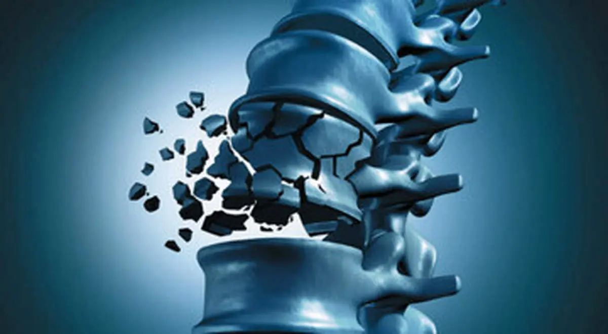 ارتباط چاقی با افزایش خطر پوکی استخوان/ هشدارهایی برای سلامت استخوانها