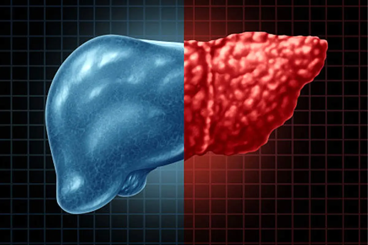 با این علائم شما کبد چرب دارید!