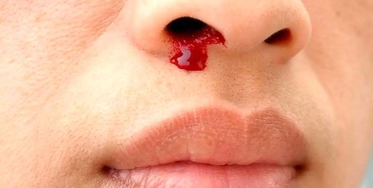 خون دماغ در این مواقع نگران کننده است!