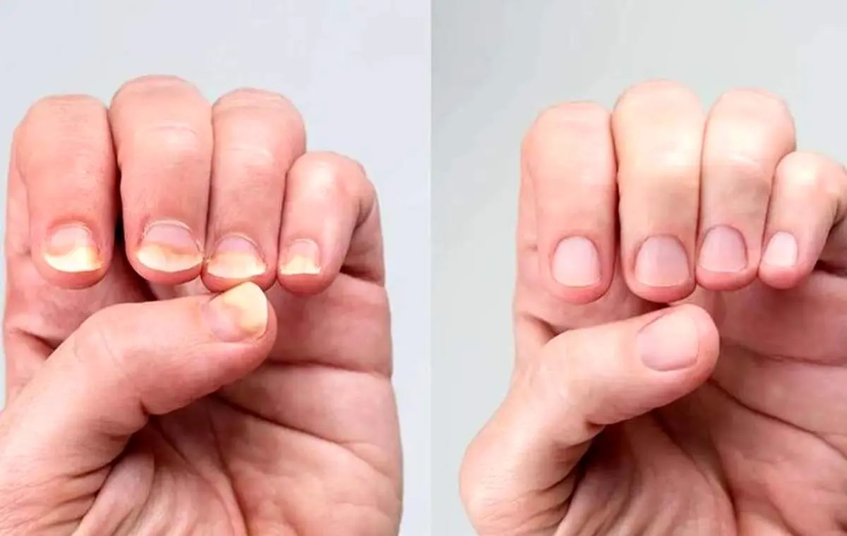 آیا سفیدی ناخنها نشانه کمخونی است