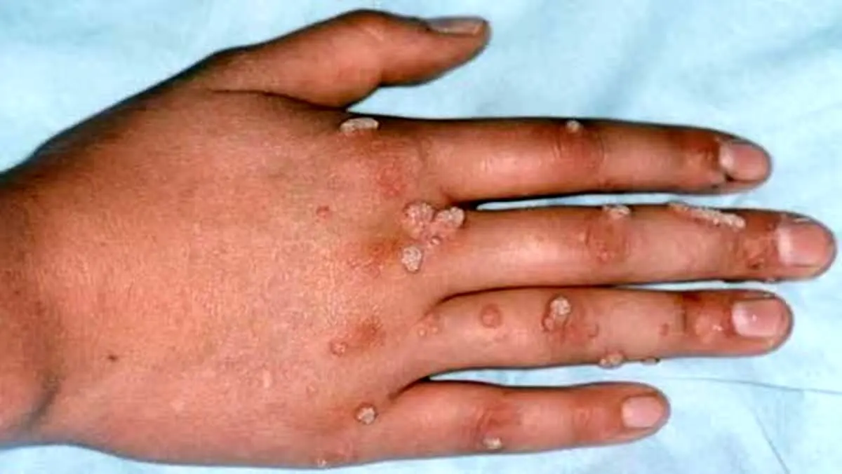 سرایت این بیماری خطرناک به آرایشگاههای زنانه؛ خانم های جوان مراقب باشند!