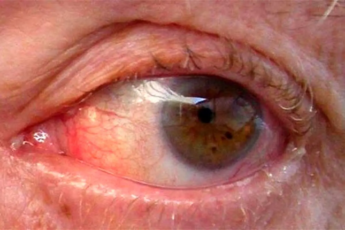 دیر درمان کنید، کور می شوید/ این بیماری علامت خاصی ندارد