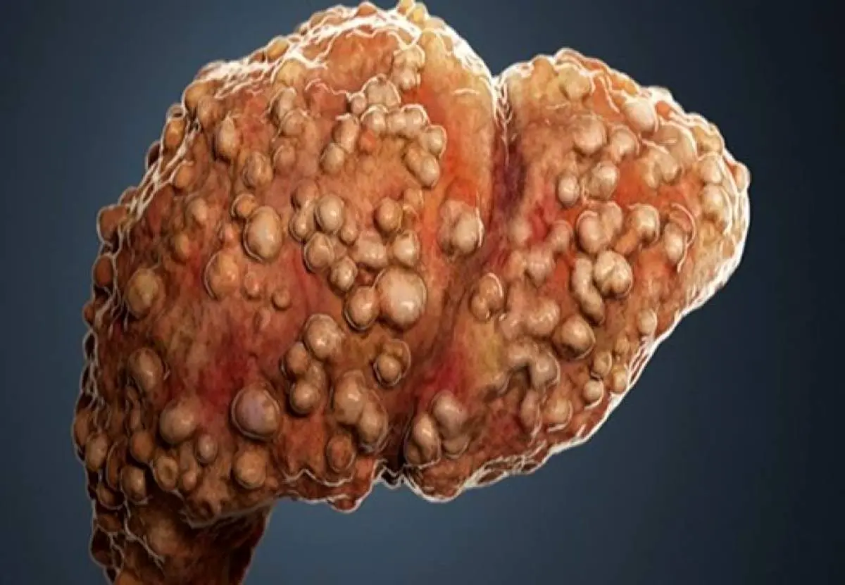 صاحبان کبدهای چرب حتما بخوانید!