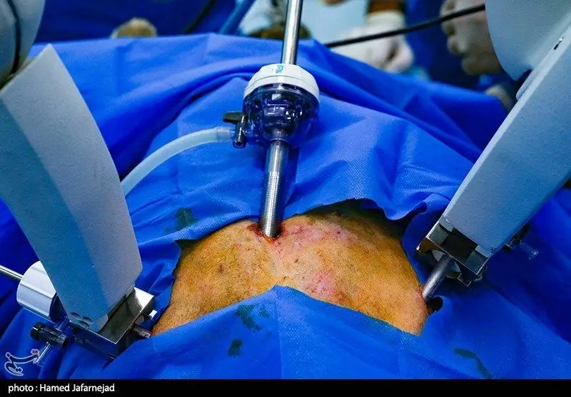 انجام عمل پیوند کبد توسط ربات جراح