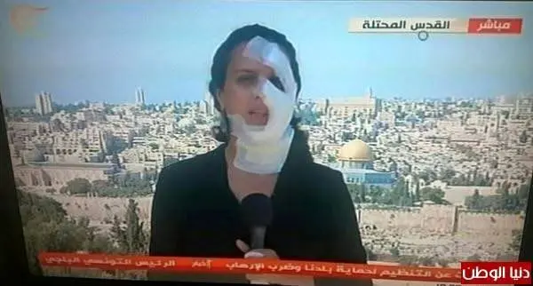 گزارش دختر خبرنگاران  با صورت باندپیچی شده