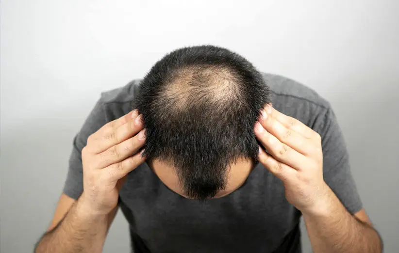 نسخه تضمینی ارزان برای جلوگیری از ریزش موی سر!