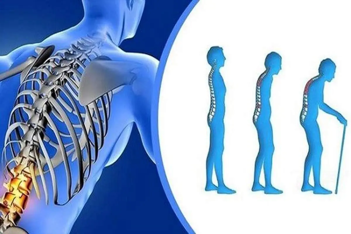 سلامت استخوانها در گرو این ۲ نوع ویتامین اصلی