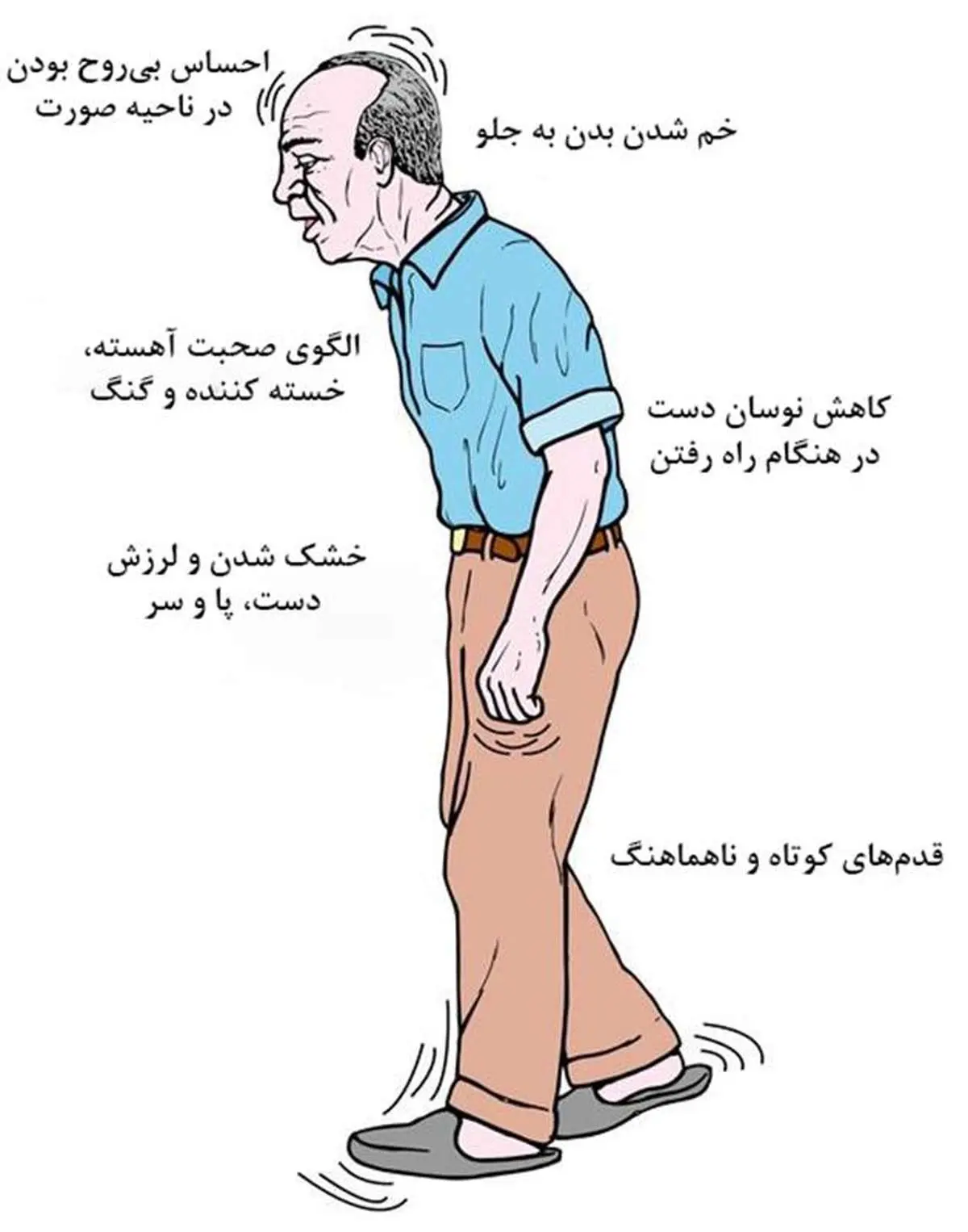 مردان ۲ برابر زنان مبتلا به پارکینسون میشوند