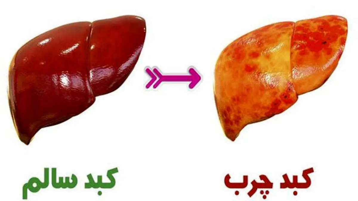 بهترین رژیم غذایی برای غلبه بر کبد چرب