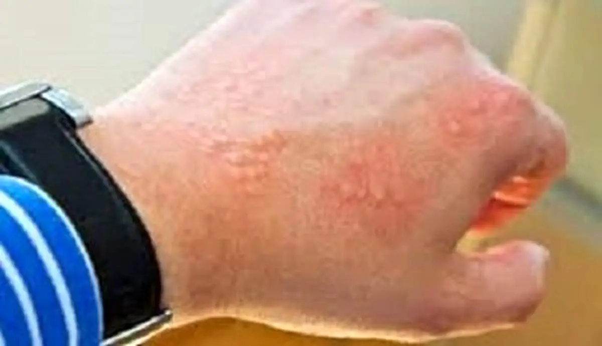 ضرورت استفاده افراد دارای پوست حساس از ضد آفتاب‌های فیزیکال