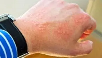 ضرورت استفاده افراد دارای پوست حساس از ضد آفتاب‌های فیزیکال