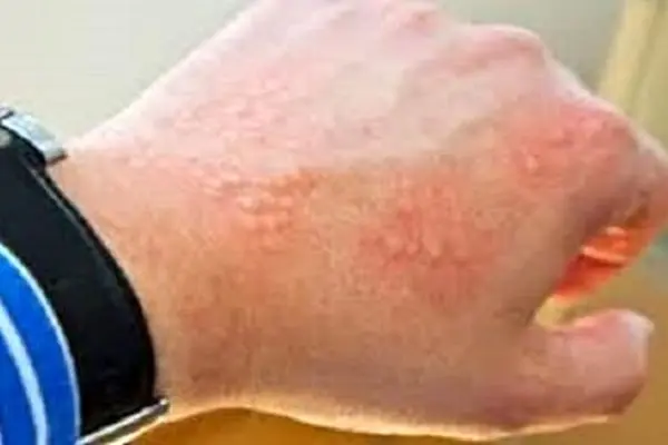 ضرورت استفاده افراد دارای پوست حساس از ضد آفتاب‌های فیزیکال