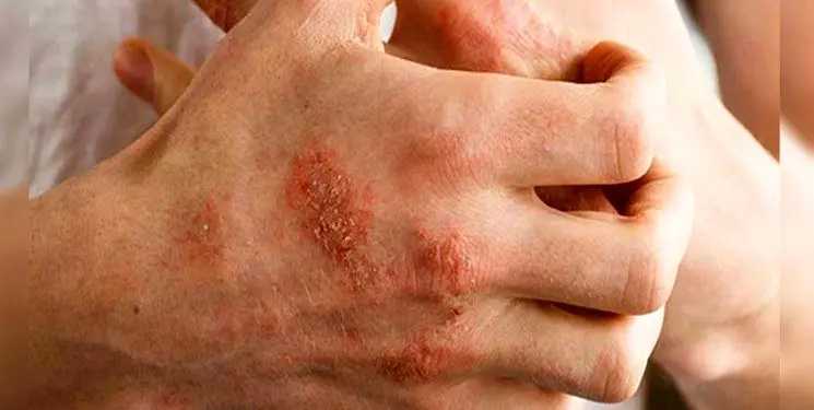 بیماری پوستی که پاییز و زمستان بیشتر است 