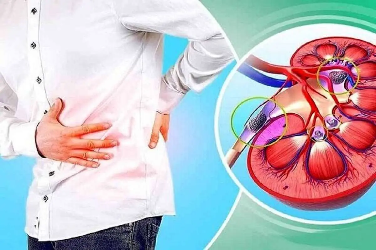سنگ کلیه و علائم شایع آن