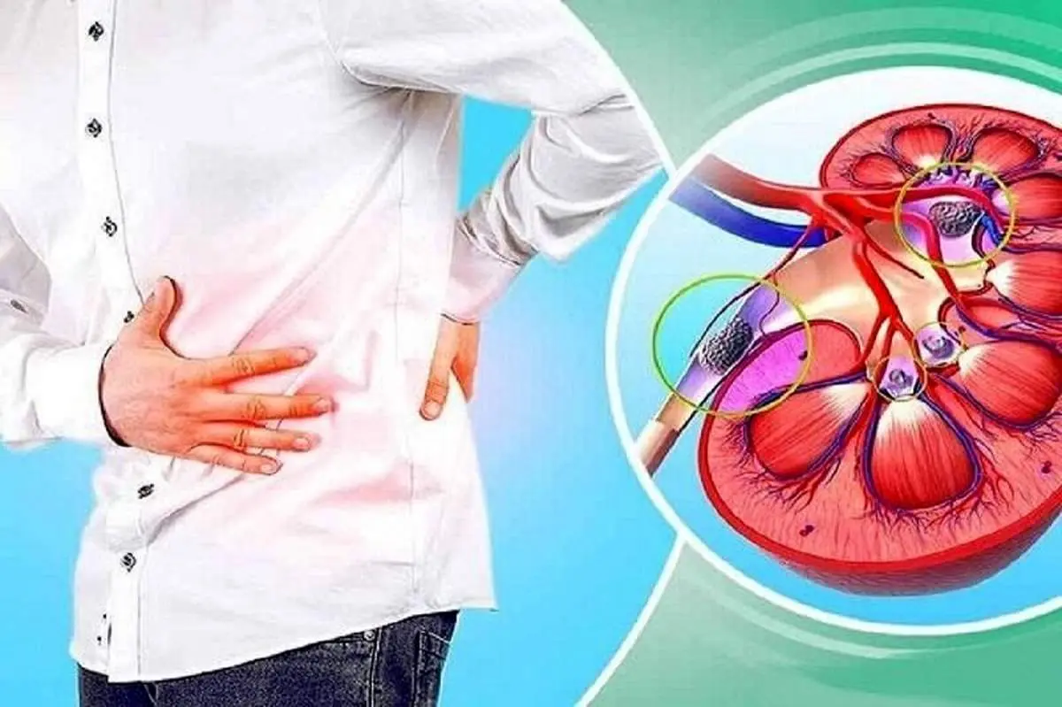 سنگ کلیه و علائم شایع آن