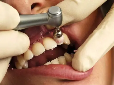کدام خدمات دندانپزشکی تحت پوشش بیمه سلامت هستند؟