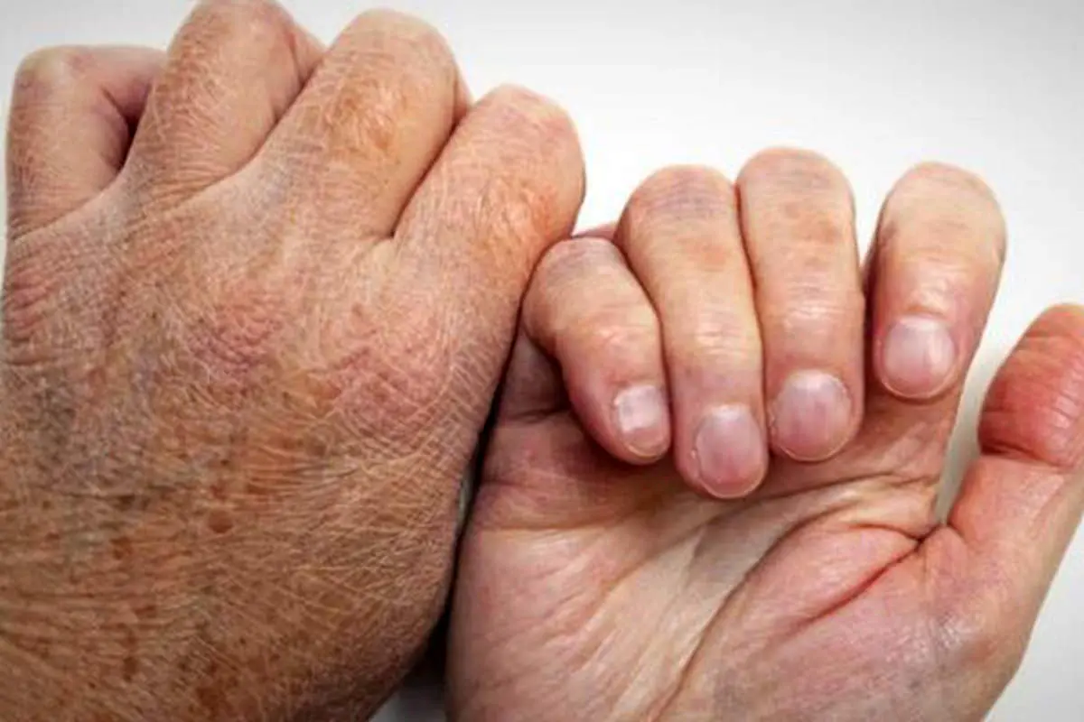 جذام سه تا پنج سال بعد از ورود باکتری نمایان می شود