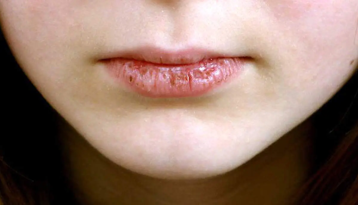 اگر دهانتان خشک می شود با این روش ها برطرفش کنید