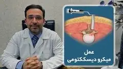 عمل میکروسکوپی دیسک کمر چیست؟ توضیحات دکتر شاه محمدی (متخصص دیسک کمر)